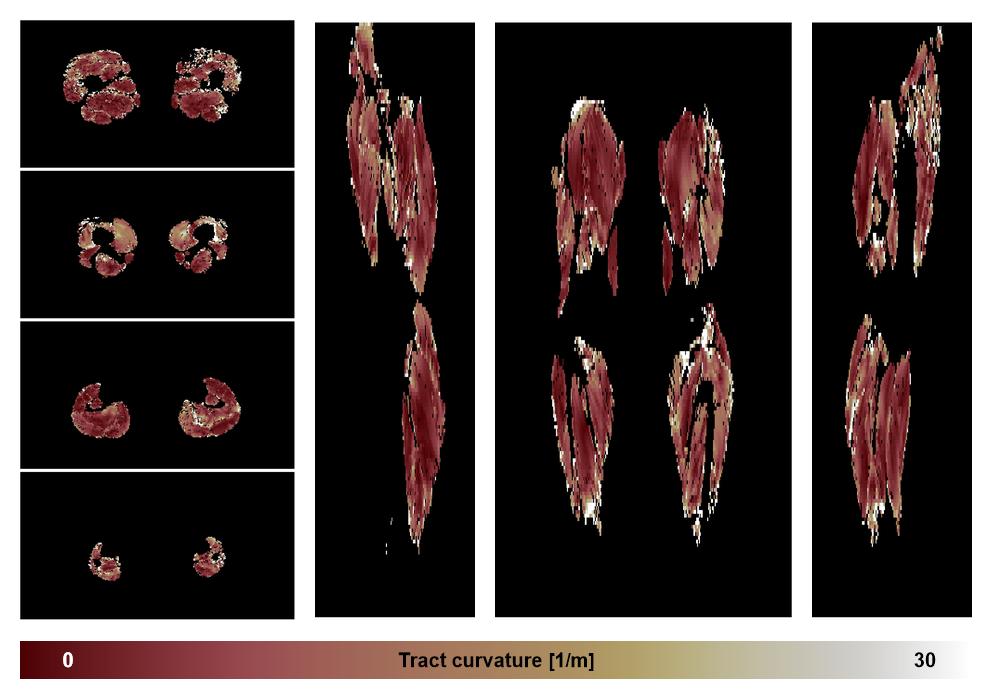 Muscle fiber tract curvature map based on whole leg DTI based fiber tractography.