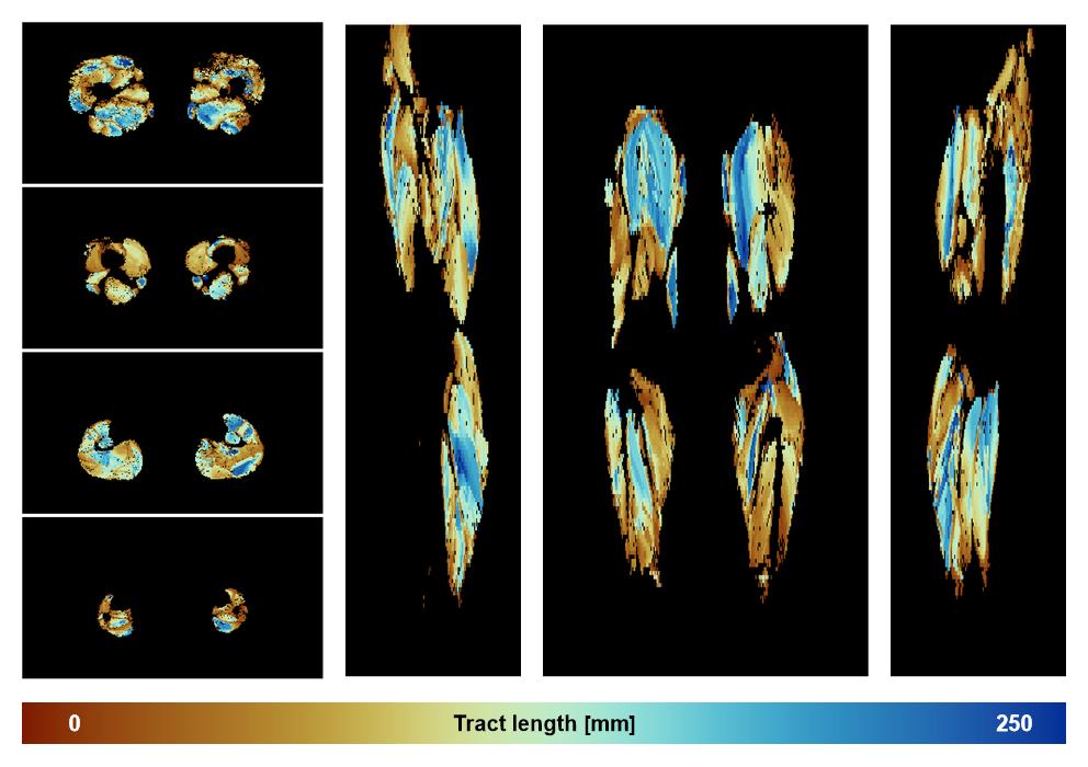 Muscle fiber tract length map based on whole leg DTI based fiber tractography.