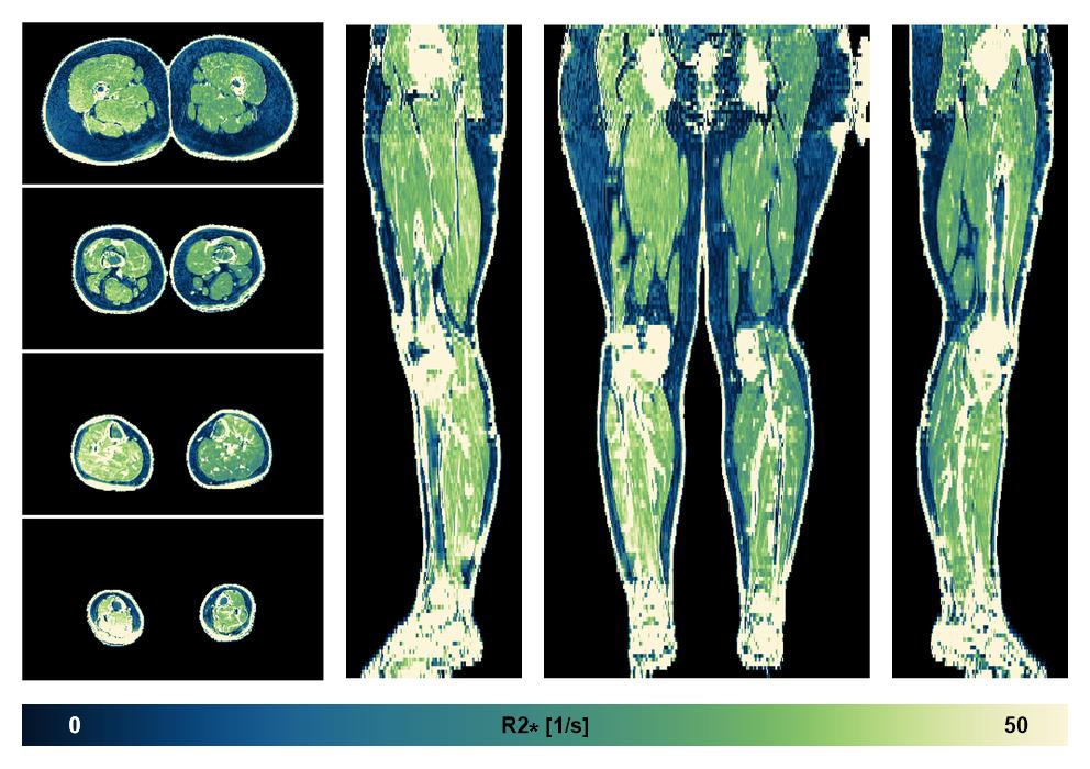 The R2 star relaxation time of the lower extremity obtained from the dixon reconstruction for muscle water fat quantification.
