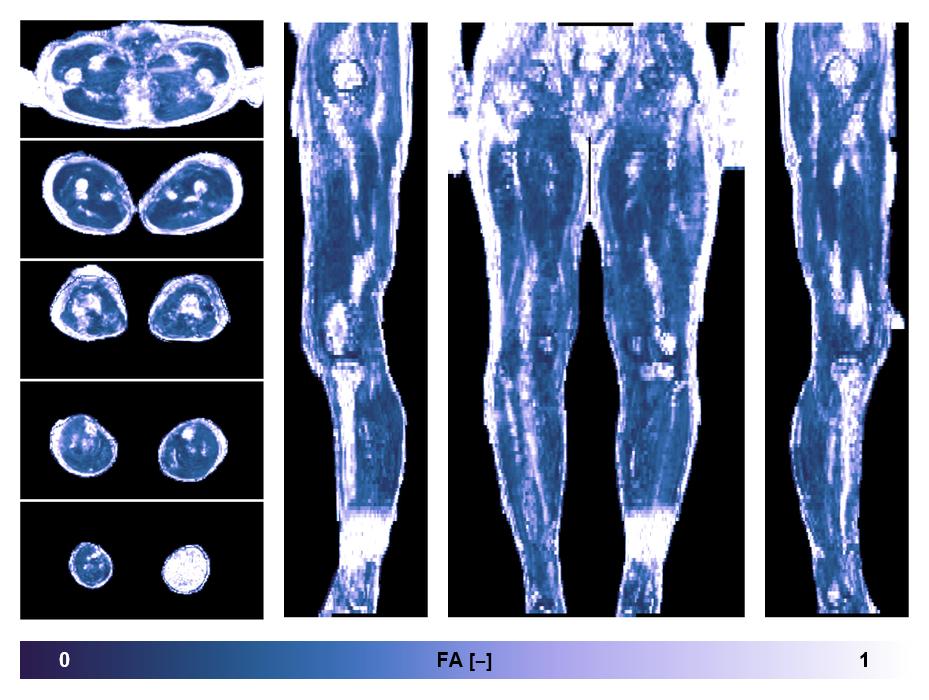 IVIM corrected whole leg muscle fractional anisotropy obtained from diffusion tensor imaging.