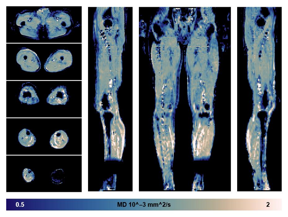 IVIM corrected whole leg muscle mean diffusivity obtained from diffusion tensor imaging.
