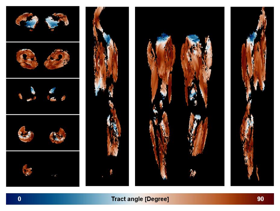 Muscle fiber tract angle map based on whole leg DTI based fiber tractography.