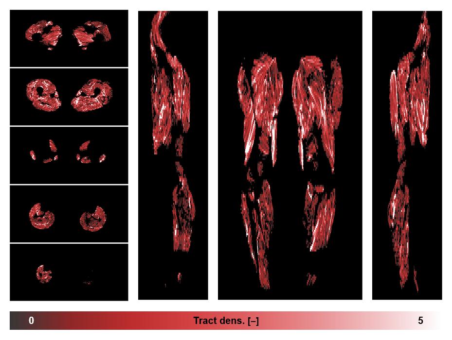 Muscle fiber tract density map based on whole leg DTI based fiber tractography.