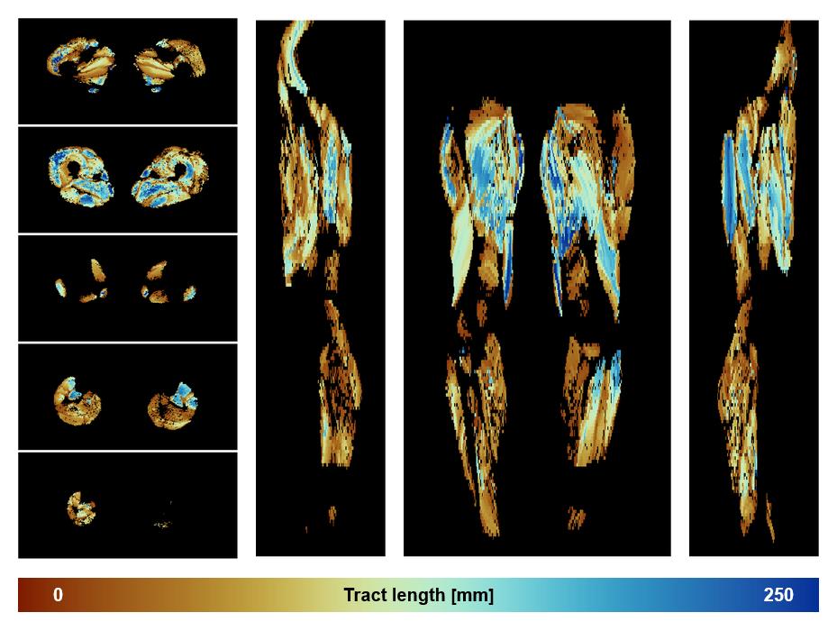 Muscle fiber tract length map based on whole leg DTI based fiber tractography.