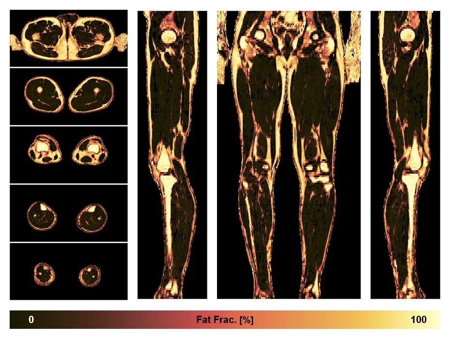 The fat fraction of the lower extremity obtained from the dixon reconstruction for muscle water fat quantification.