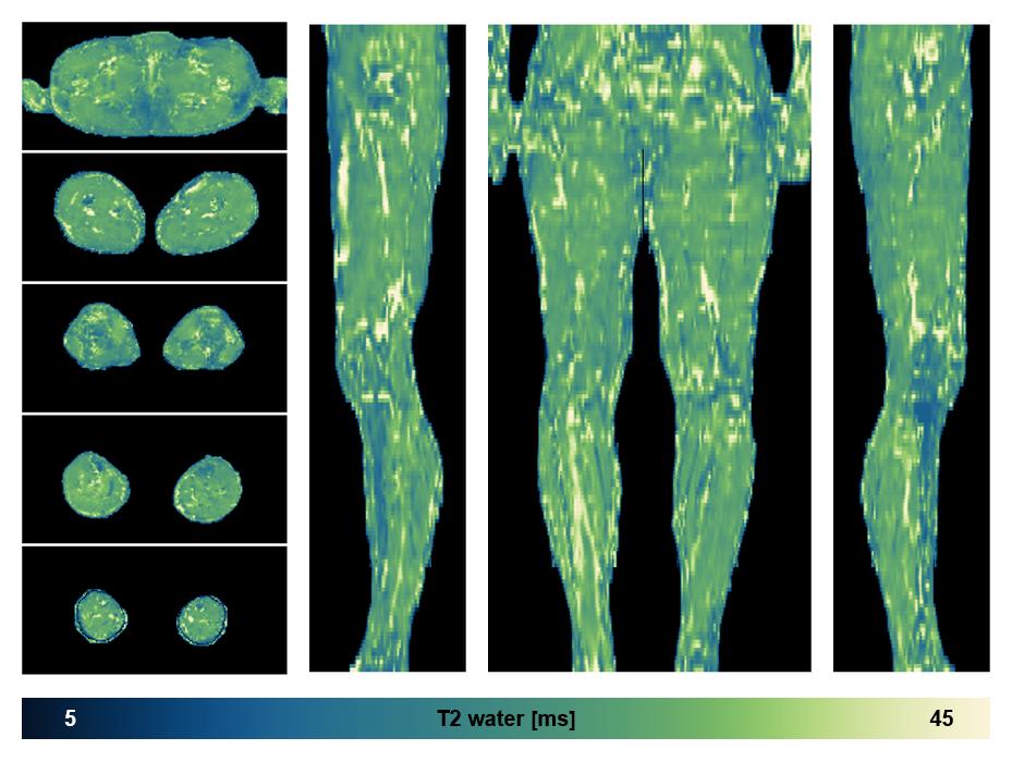 The water only T2 relaxation time of the lower extremity obtained from multi echo spin echo t2 mapping with EPG based reconstruction.