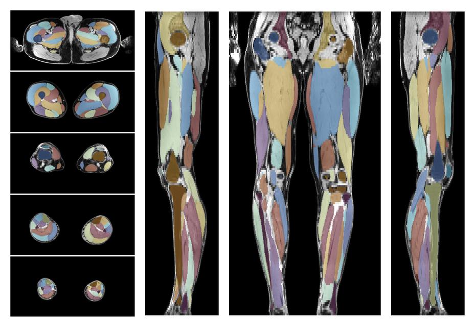 Overlay of automated muscle segmentation labels on dixon water image.
