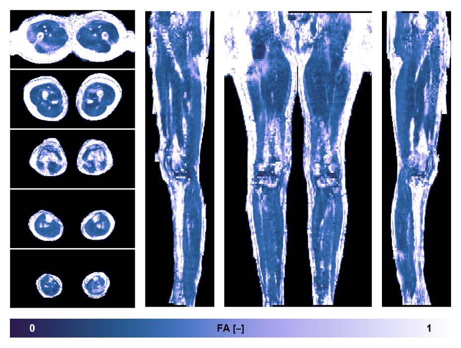 IVIM corrected whole leg muscle fractional anisotropy obtained from diffusion tensor imaging.
