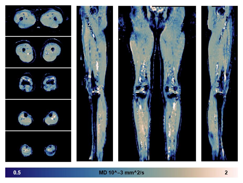 IVIM corrected whole leg muscle mean diffusivity obtained from diffusion tensor imaging.