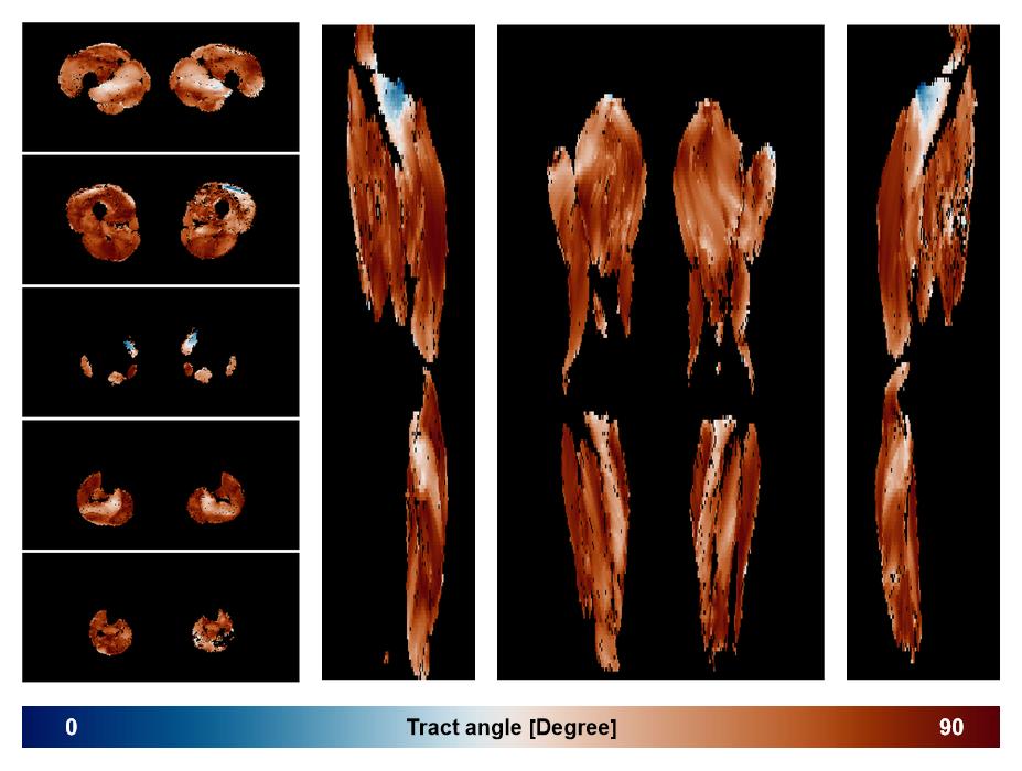 Muscle fiber tract angle map based on whole leg DTI based fiber tractography.