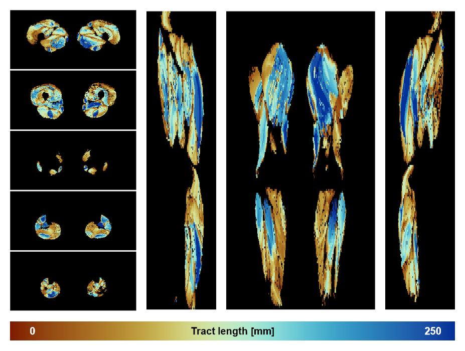Muscle fiber tract length map based on whole leg DTI based fiber tractography.