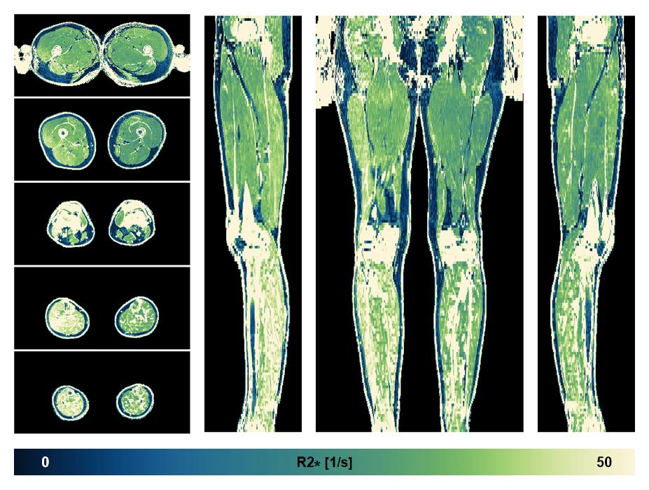 The R2 star relaxation time of the lower extremity obtained from the dixon reconstruction for muscle water fat quantification.