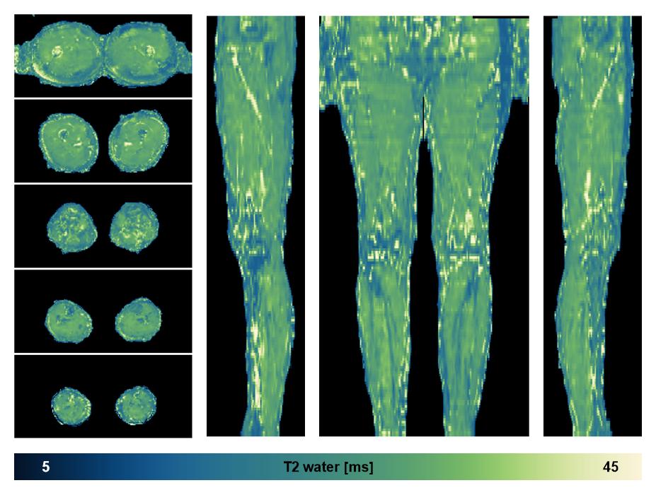 The water only T2 relaxation time of the lower extremity obtained from multi echo spin echo t2 mapping with EPG based reconstruction.