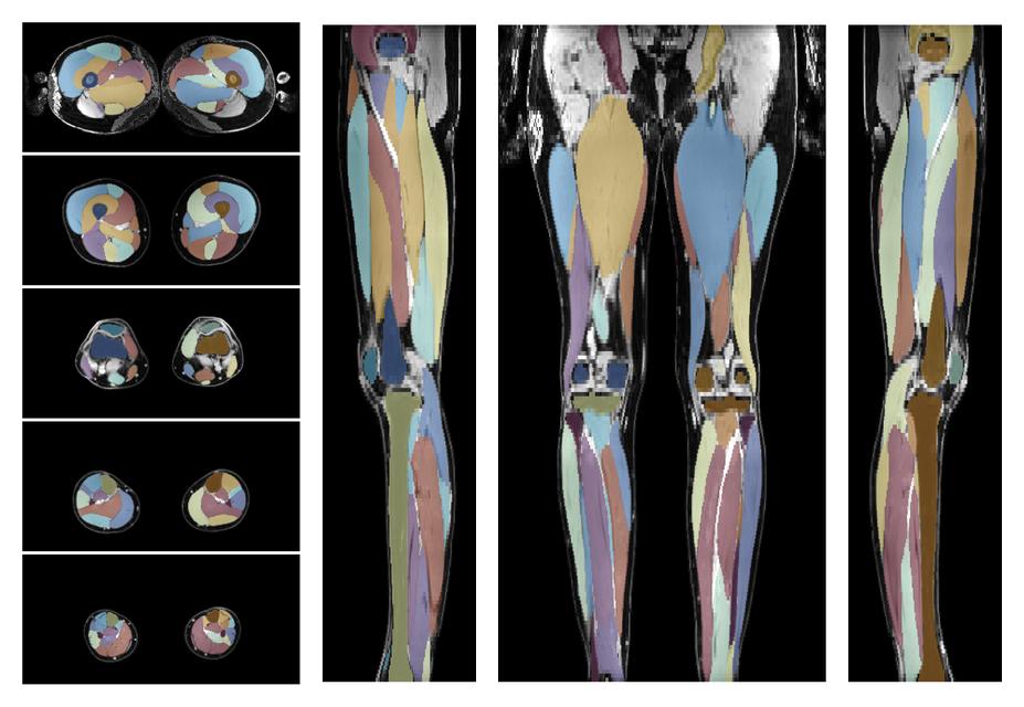 Overlay of automated muscle segmentation labels on dixon water image.