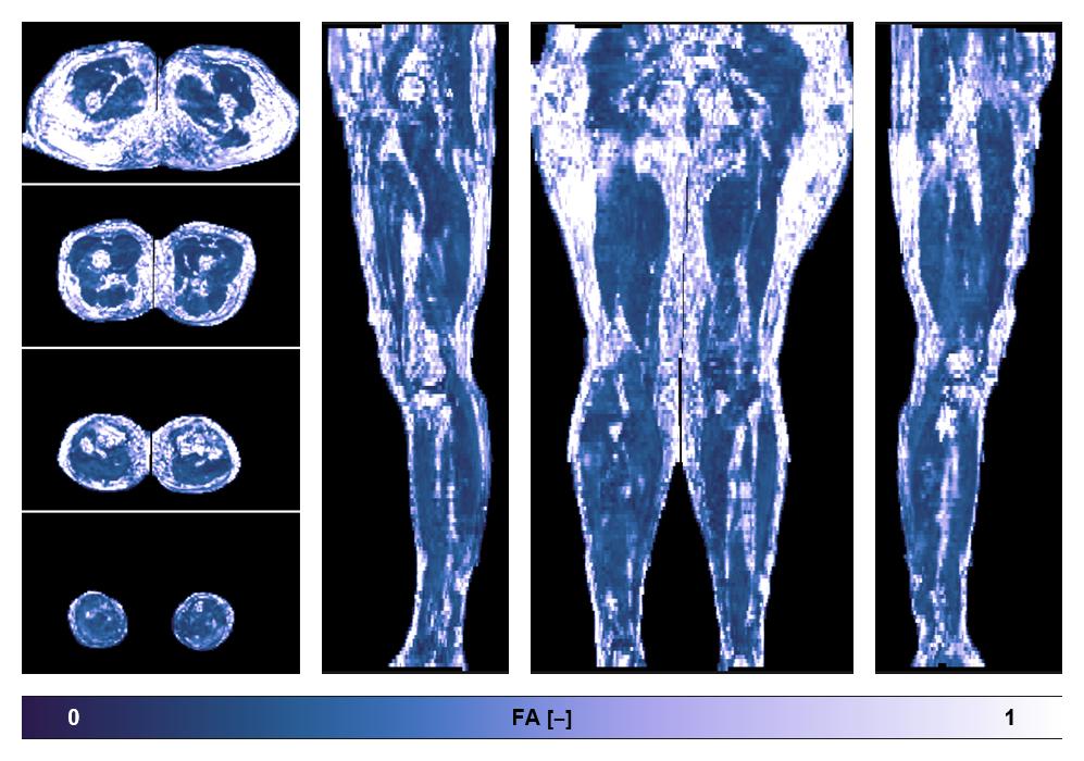 IVIM corrected whole leg muscle fractional anisotropy obtained from diffusion tensor imaging.