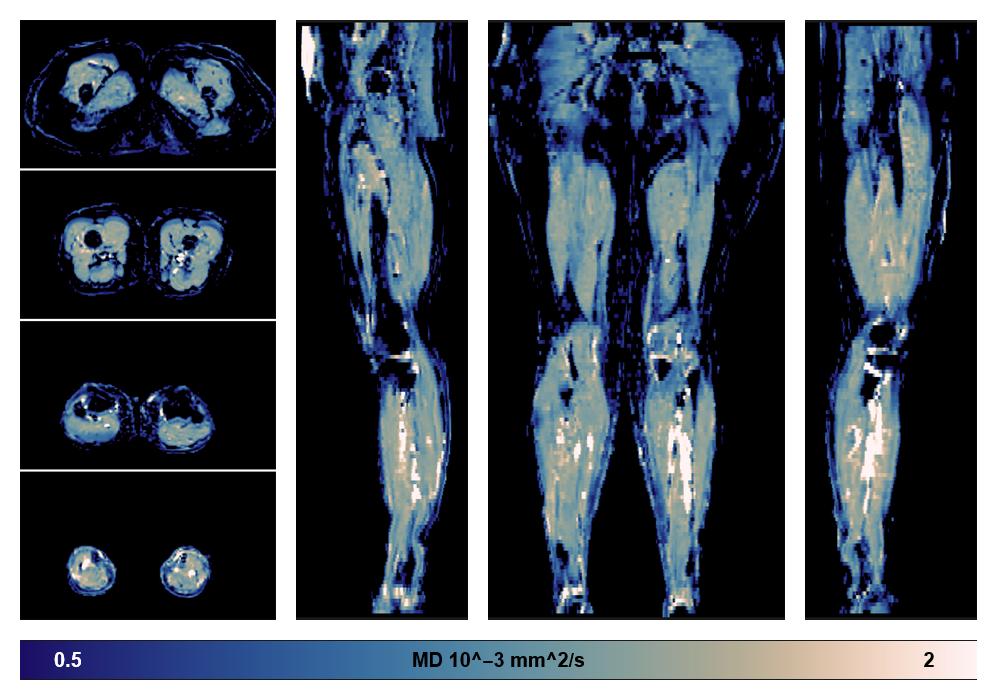 IVIM corrected whole leg muscle mean diffusivity obtained from diffusion tensor imaging.