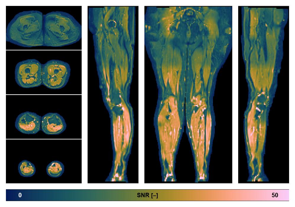 SNR distribution of the unweighted diffusion data.