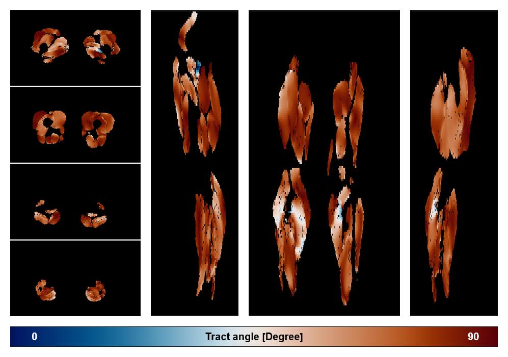 Muscle fiber tract angle map based on whole leg DTI based fiber tractography.