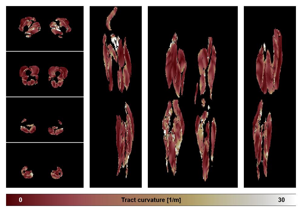 Muscle fiber tract curvature map based on whole leg DTI based fiber tractography.
