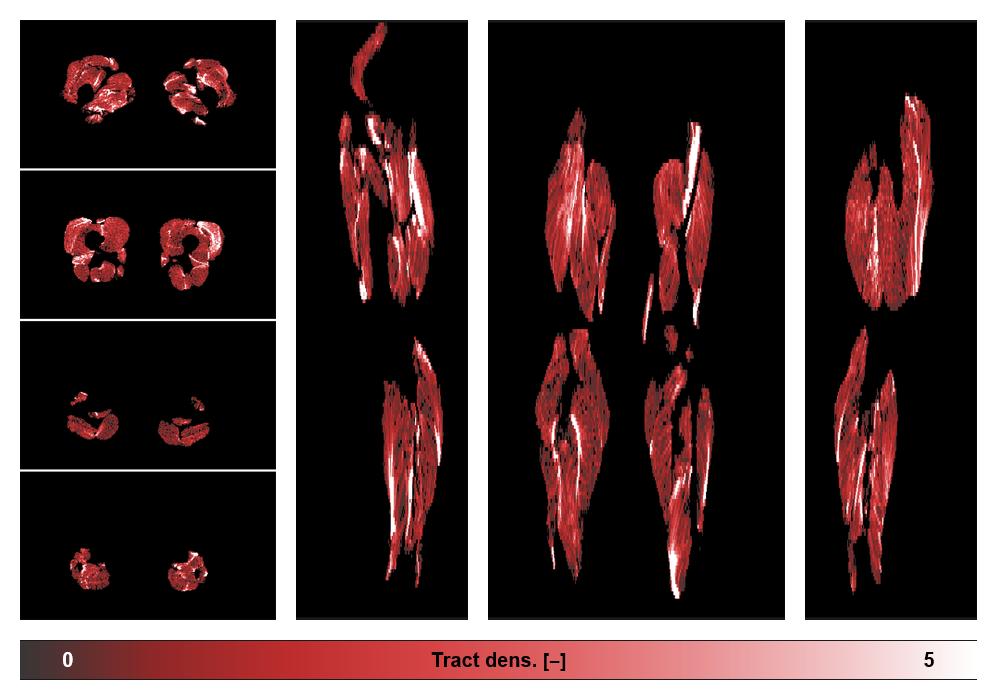 Muscle fiber tract density map based on whole leg DTI based fiber tractography.