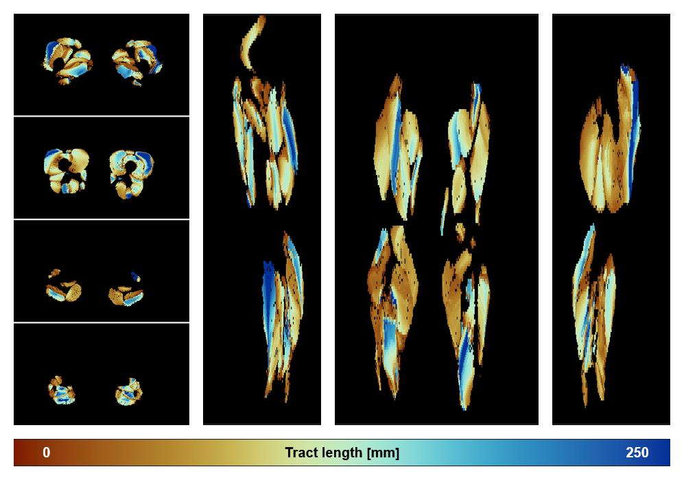 Muscle fiber tract length map based on whole leg DTI based fiber tractography.