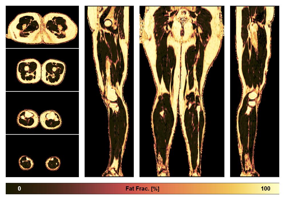 The fat fraction of the lower extremity obtained from the dixon reconstruction for muscle water fat quantification.