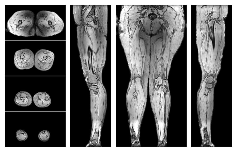 The out-phase image of the dixon reconstruction for water fat quantification.