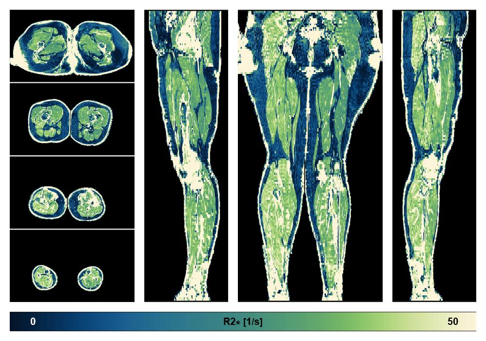 The R2 star relaxation time of the lower extremity obtained from the dixon reconstruction for muscle water fat quantification.