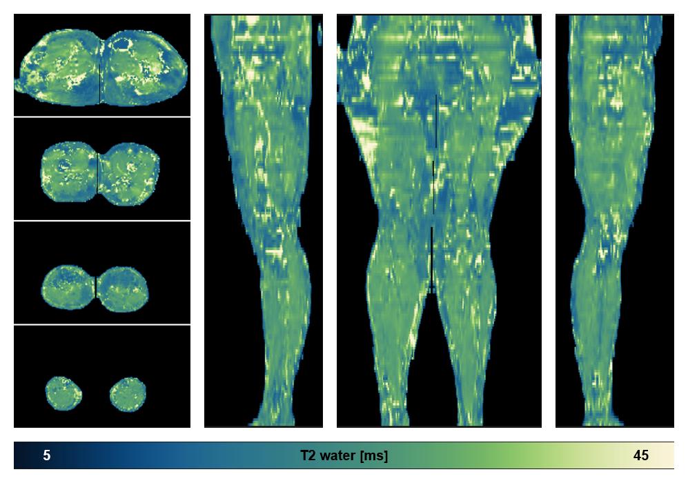 The water only T2 relaxation time of the lower extremity obtained from multi echo spin echo t2 mapping with EPG based reconstruction.
