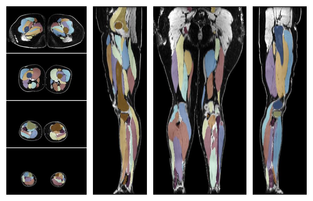 Overlay of automated muscle segmentation labels on dixon water image.