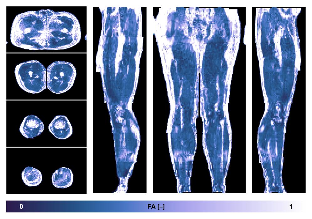 IVIM corrected whole leg muscle fractional anisotropy obtained from diffusion tensor imaging.