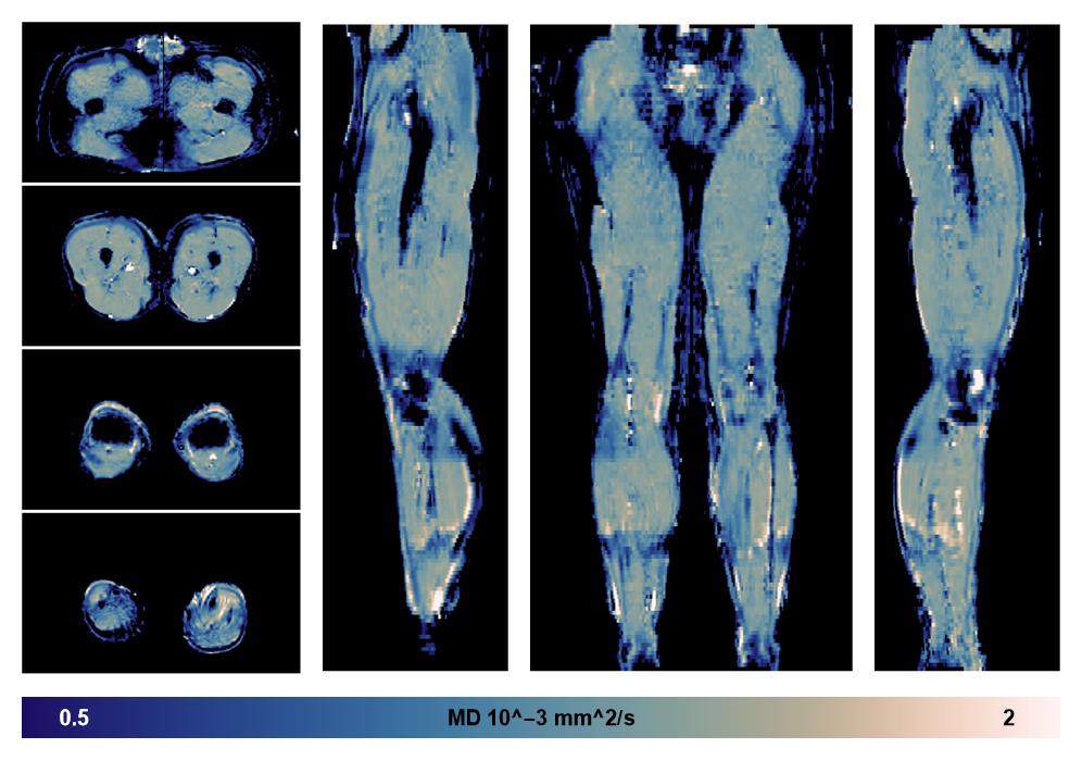 IVIM corrected whole leg muscle mean diffusivity obtained from diffusion tensor imaging.