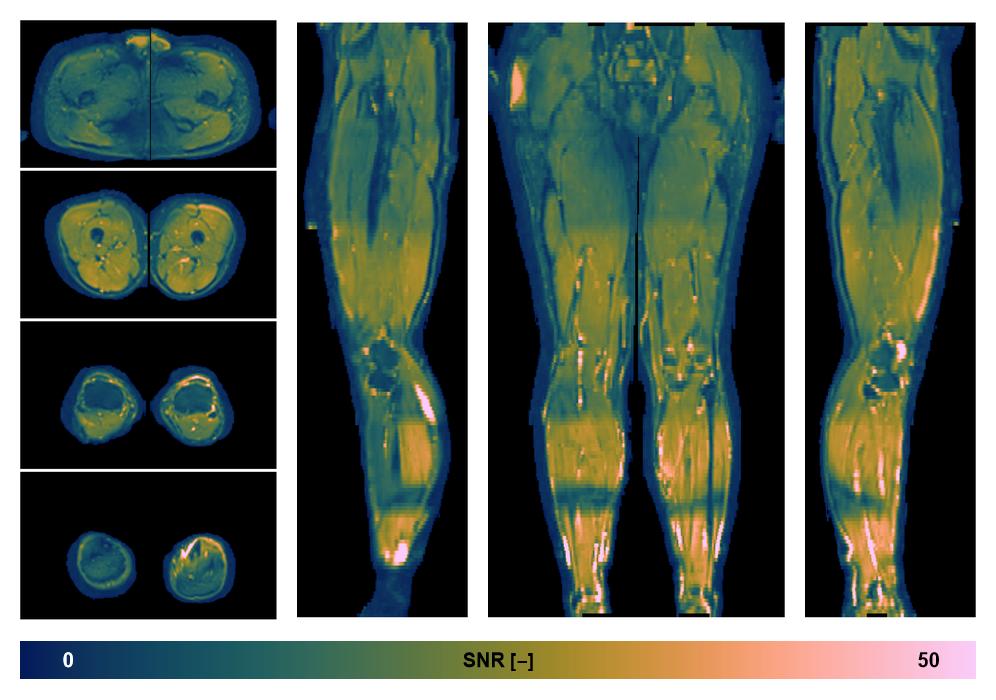 SNR distribution of the unweighted diffusion data.