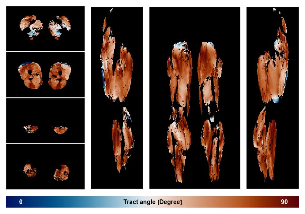 Muscle fiber tract angle map based on whole leg DTI based fiber tractography.