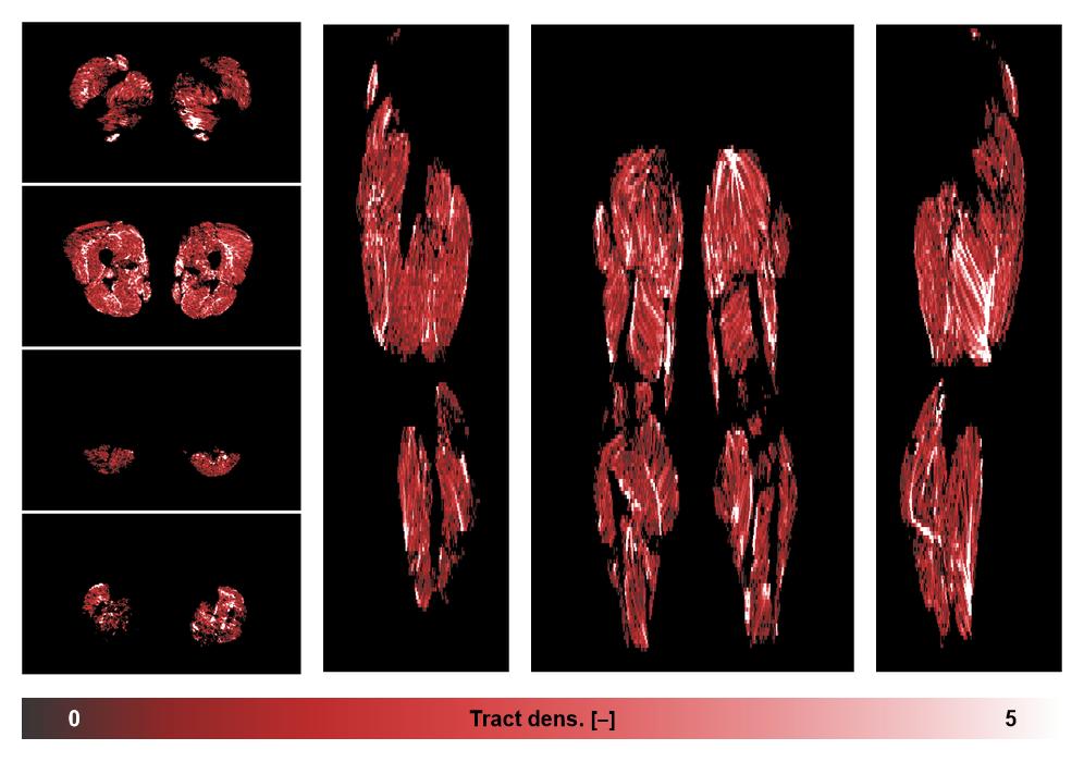 Muscle fiber tract density map based on whole leg DTI based fiber tractography.