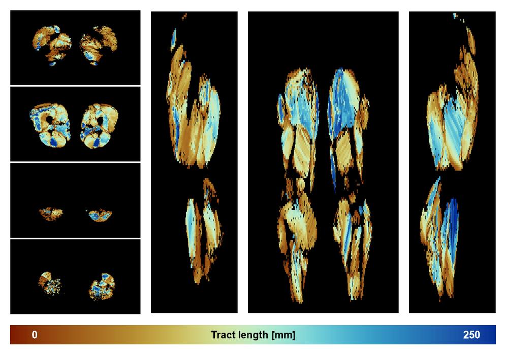 Muscle fiber tract length map based on whole leg DTI based fiber tractography.
