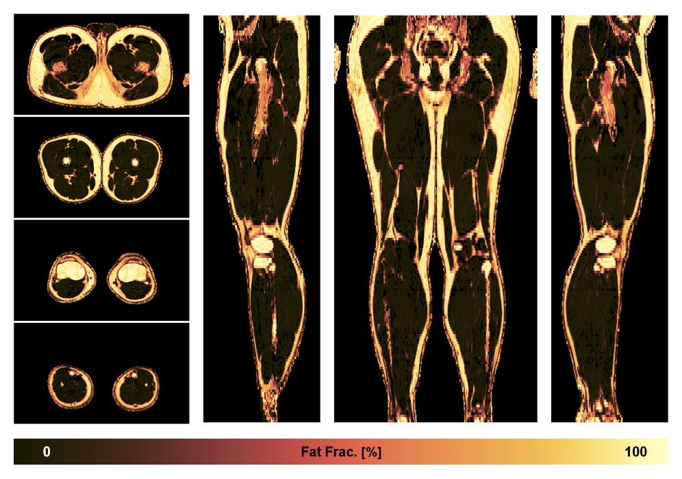 The fat fraction of the lower extremity obtained from the dixon reconstruction for muscle water fat quantification.