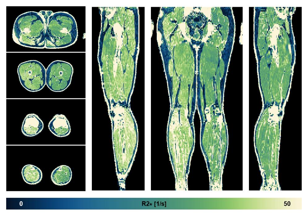 The R2 star relaxation time of the lower extremity obtained from the dixon reconstruction for muscle water fat quantification.