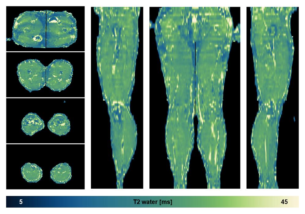 The water only T2 relaxation time of the lower extremity obtained from multi echo spin echo t2 mapping with EPG based reconstruction.