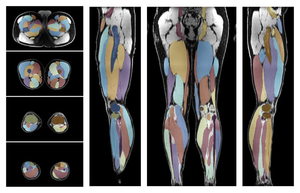 Overlay of automated muscle segmentation labels on dixon water image.