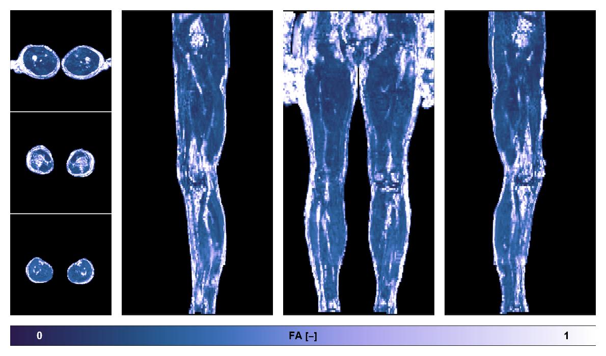 IVIM corrected whole leg muscle fractional anisotropy obtained from diffusion tensor imaging.