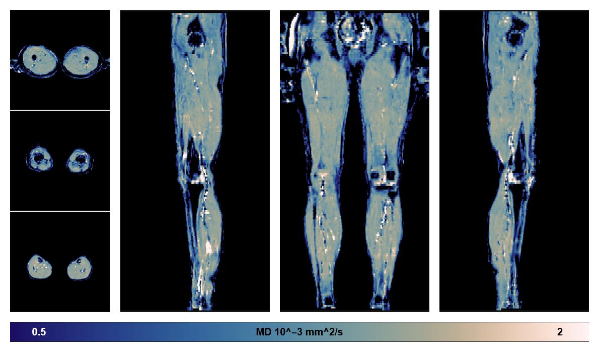 IVIM corrected whole leg muscle mean diffusivity obtained from diffusion tensor imaging.