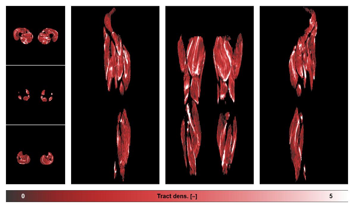 Muscle fiber tract density map based on whole leg DTI based fiber tractography.