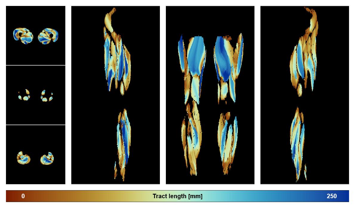 Muscle fiber tract length map based on whole leg DTI based fiber tractography.