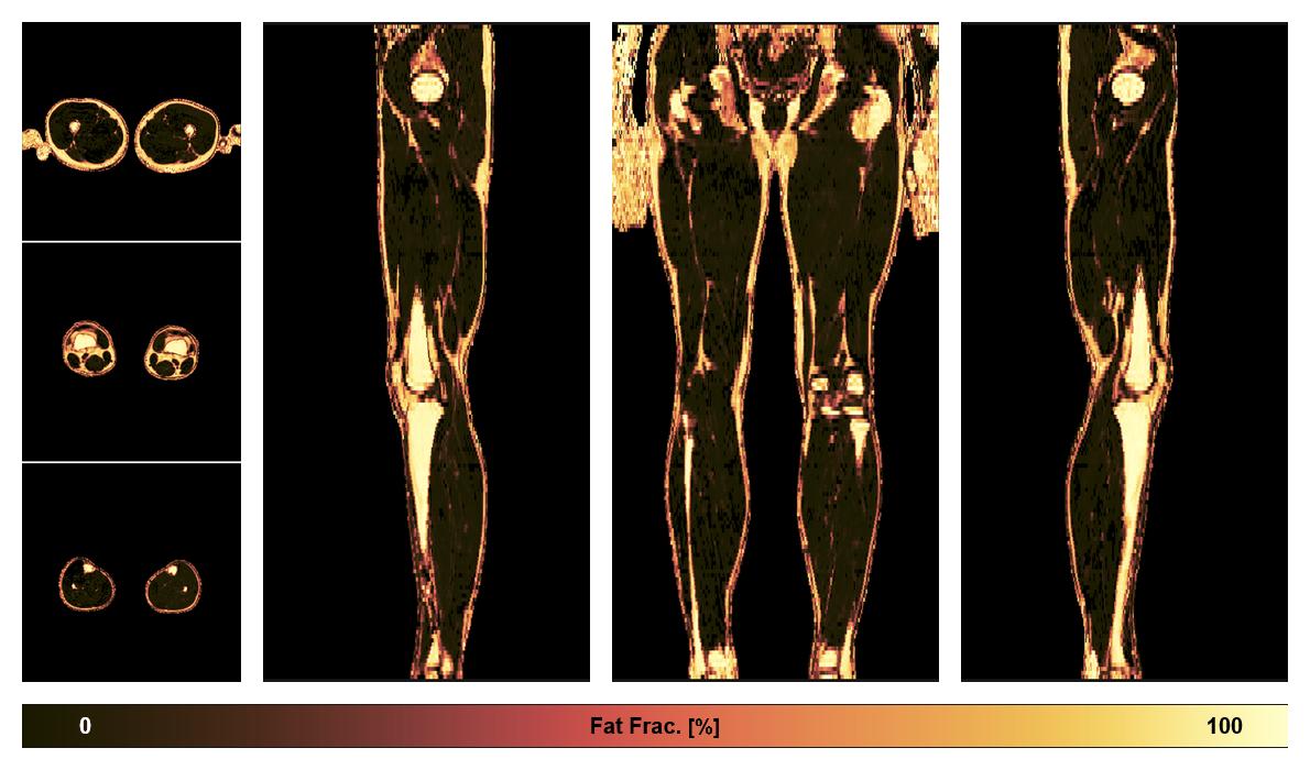 The fat fraction of the lower extremity obtained from the dixon reconstruction for muscle water fat quantification.