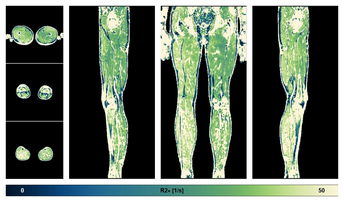 The R2 star relaxation time of the lower extremity obtained from the dixon reconstruction for muscle water fat quantification.