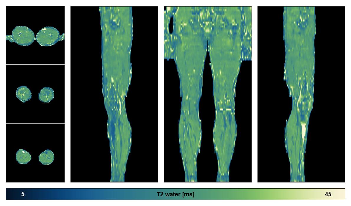 The water only T2 relaxation time of the lower extremity obtained from multi echo spin echo t2 mapping with EPG based reconstruction.