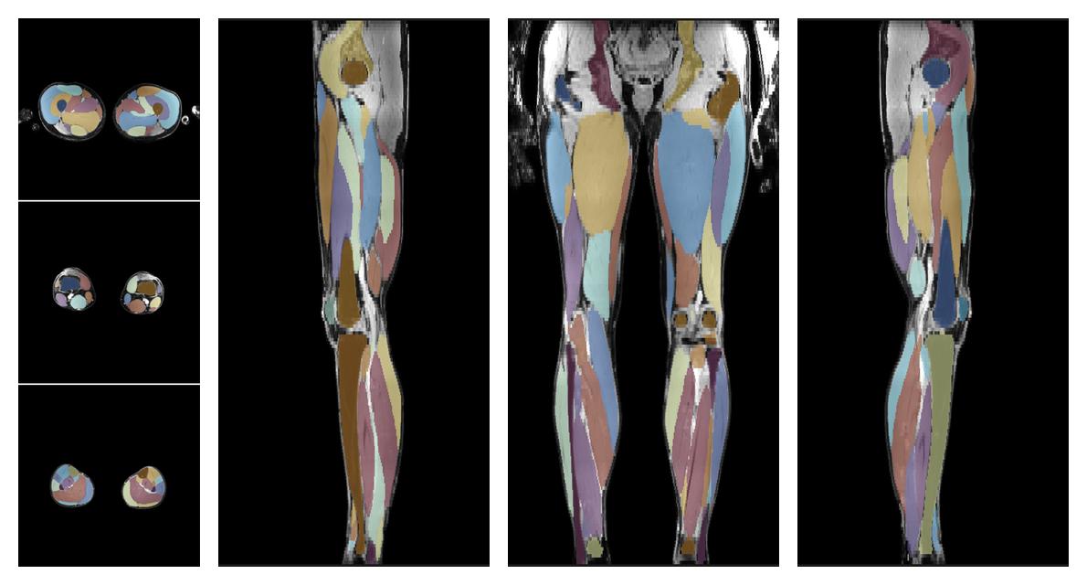 Overlay of automated muscle segmentation labels on dixon water image.