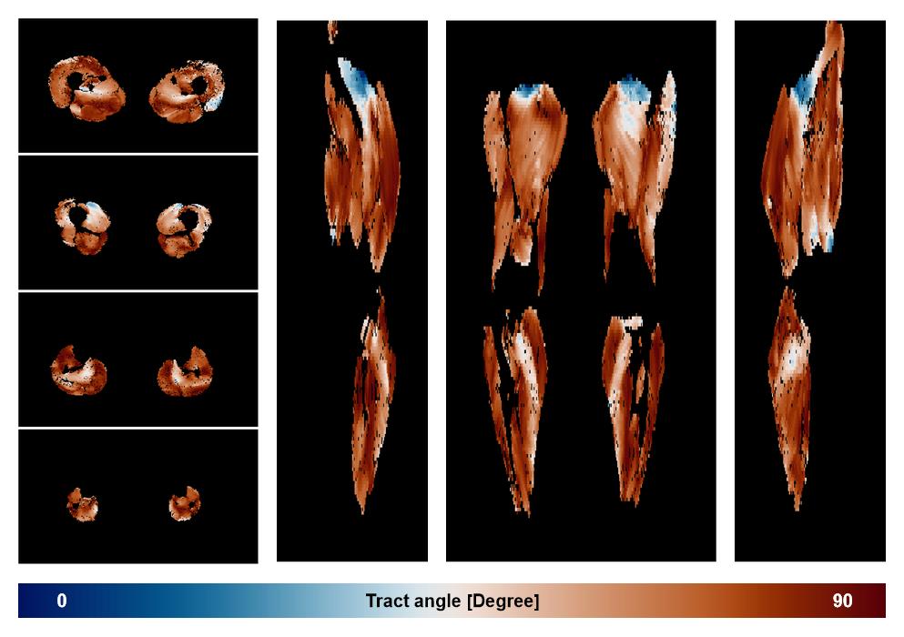Muscle fiber tract angle map based on whole leg DTI based fiber tractography.