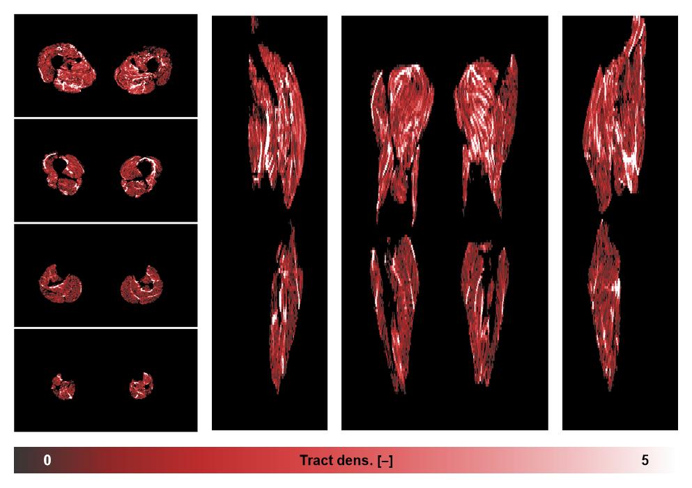 Muscle fiber tract density map based on whole leg DTI based fiber tractography.